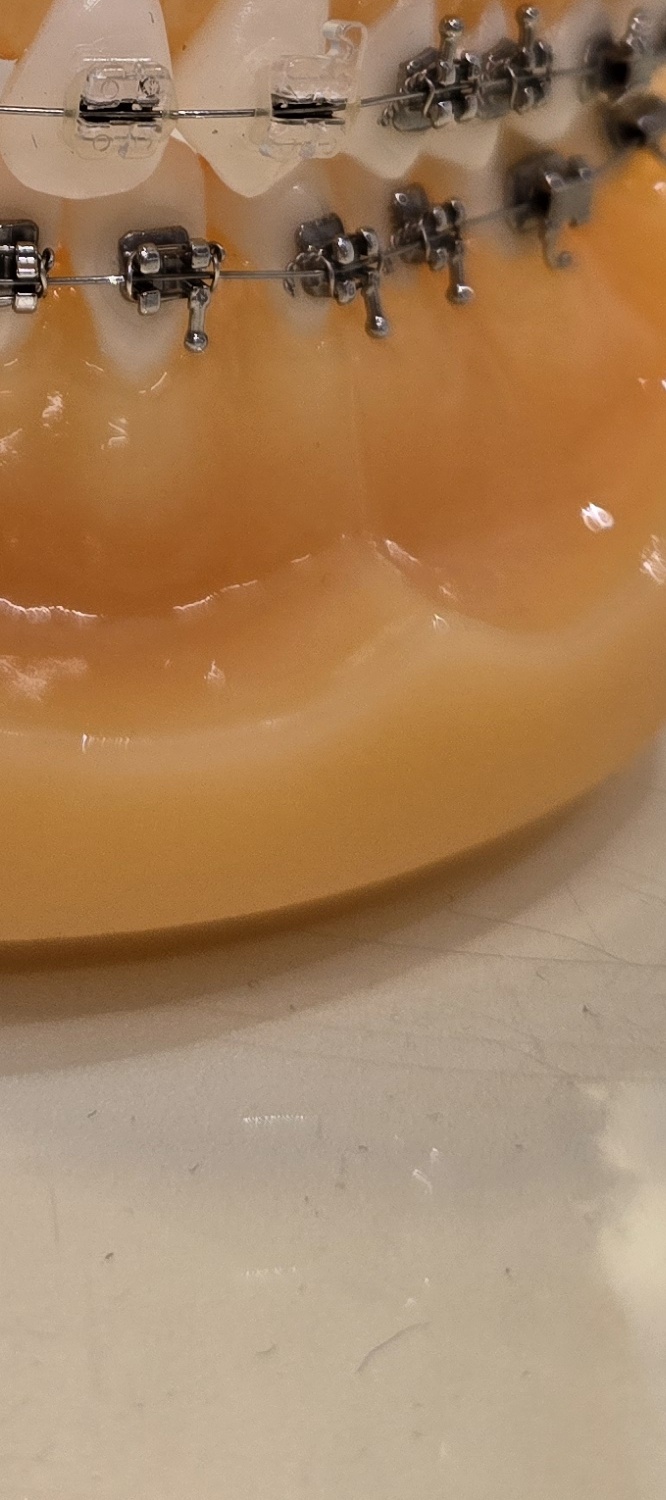 송곳니 덧니 발치 이럴때 해당되네요 관련 이미지 21