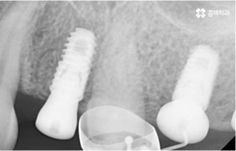 명동치과 타고난 이의 수명은 관련 이미지 10