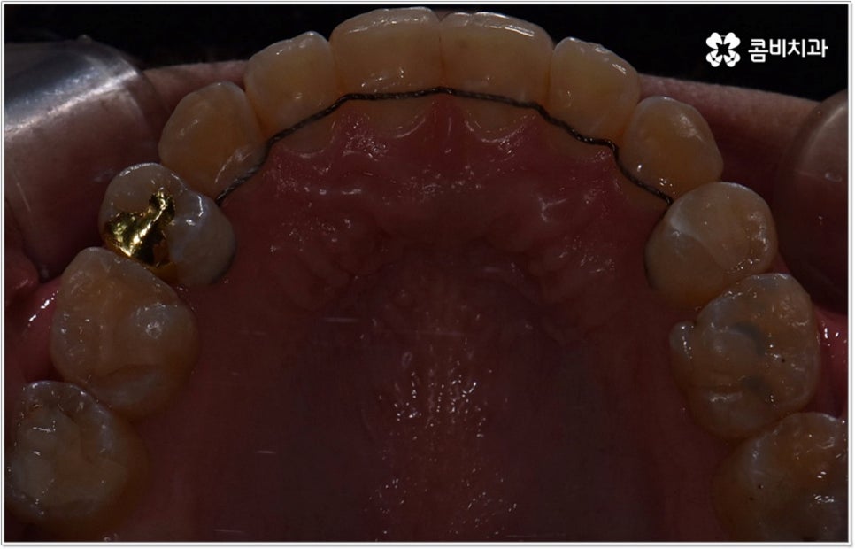 비발치치아교정 언제 할수있나요 관련 이미지 13