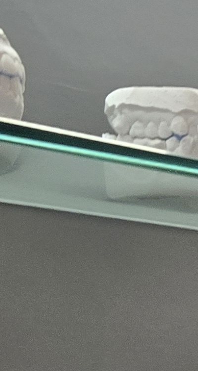 완전매복사랑니 발치 대학병원 꼭 가야하나요 관련 이미지 22