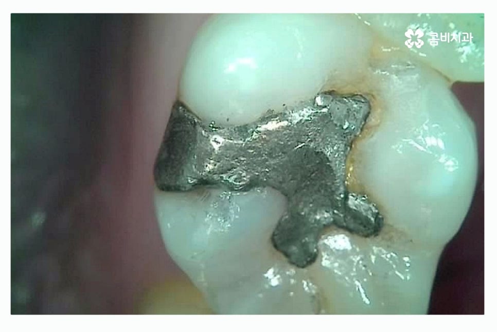 충치 레진 인레이 합리적으로 결정하려면 관련 이미지 6