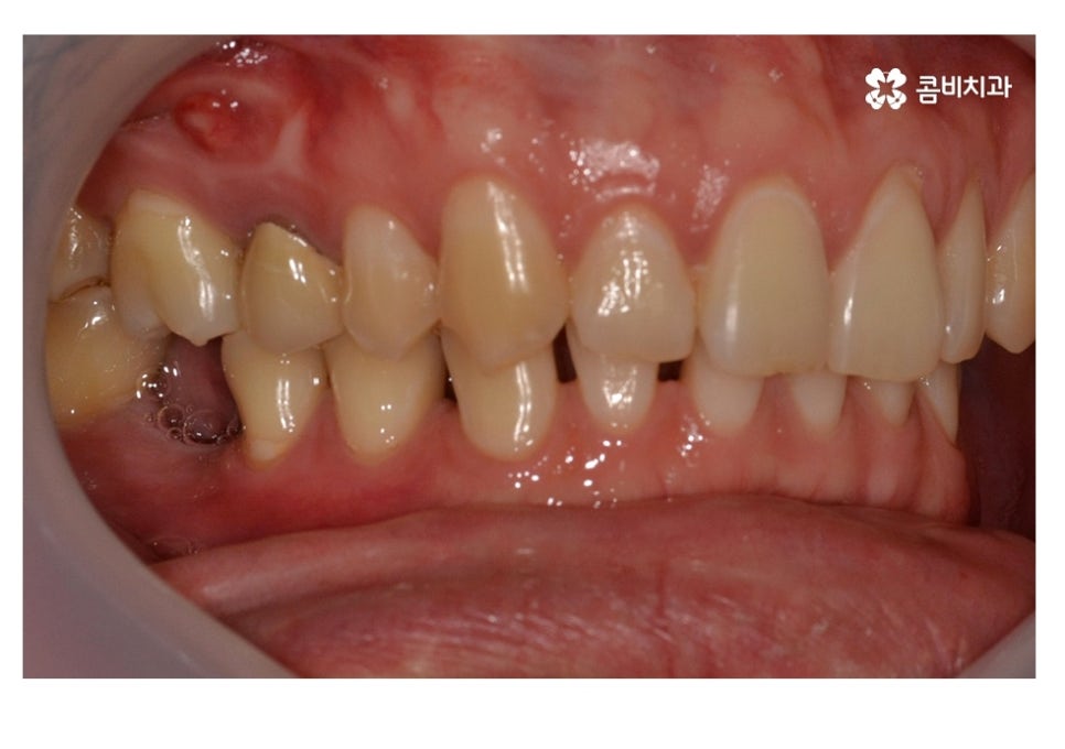 20대임플란트 잦아지는 이유를 알아본다면 관련 이미지 4