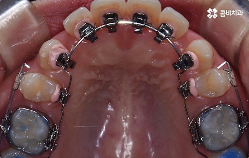 직장인치아교정 어떻게 시작하나요? 관련 이미지 9