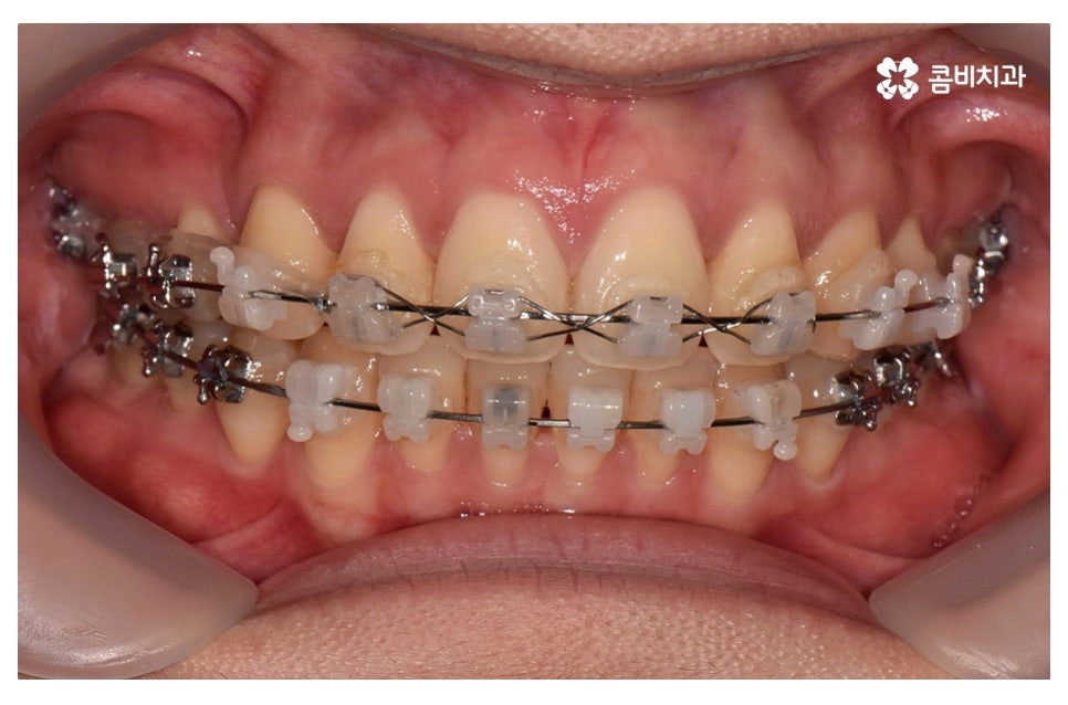 덧니교정 정확하게 알아보려면 관련 이미지 11