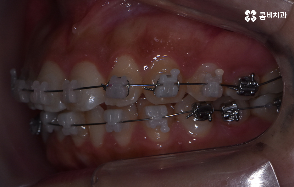 덧니 발치 교정 이런 경우에는 필요합니다 관련 이미지 9