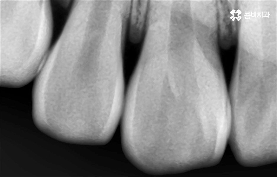 앞니 돌출 어떻게 고치나요? 관련 이미지 10