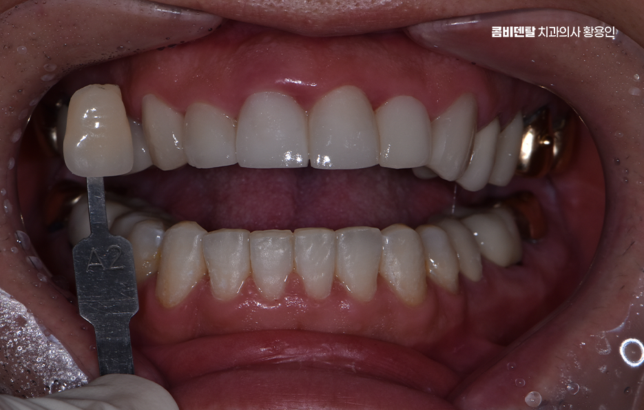 How to Use Laminate Veneers for Chipped Front Teeth image 5
