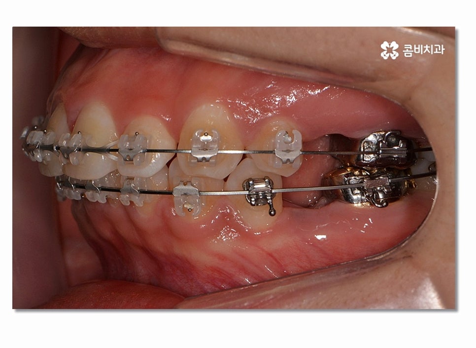 돌출입치아교정 부담이 크게 느껴진다면 관련 이미지 6