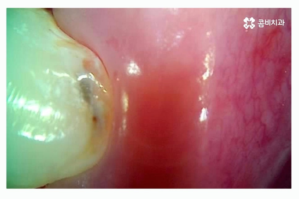 충치 레진 인레이 합리적으로 결정하려면 관련 이미지 11
