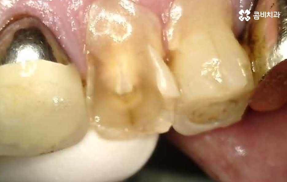 발치후 임플란트 기간 현실적으로 알아보면 관련 이미지 3