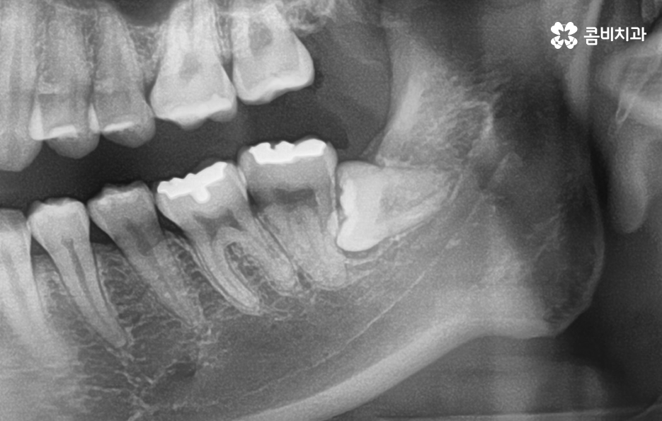 누워있는 사랑니 꼭 뽑아야 하는 경우는 언제일까 관련 이미지 2
