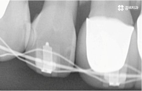 명동치과 타고난 이의 수명은 관련 이미지 17