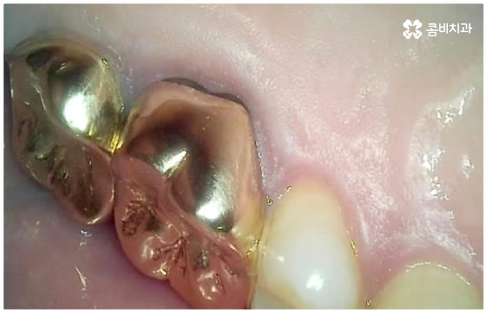 어금니충치치료 아프다면 빨리 관련 이미지 4