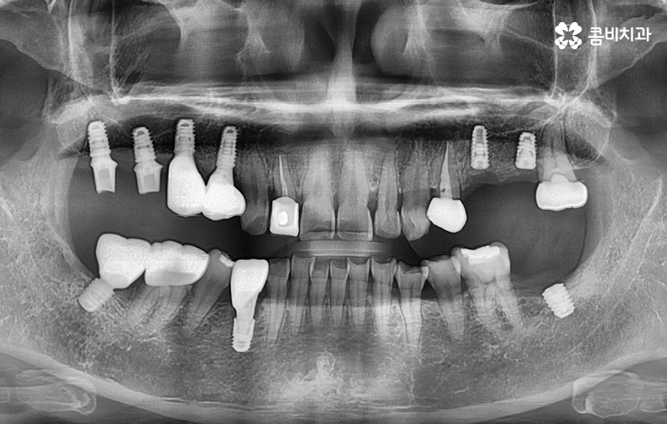 임플란트 치료기간 어느정도 걸리고 치과에는 몇번 가나요 관련 이미지 12