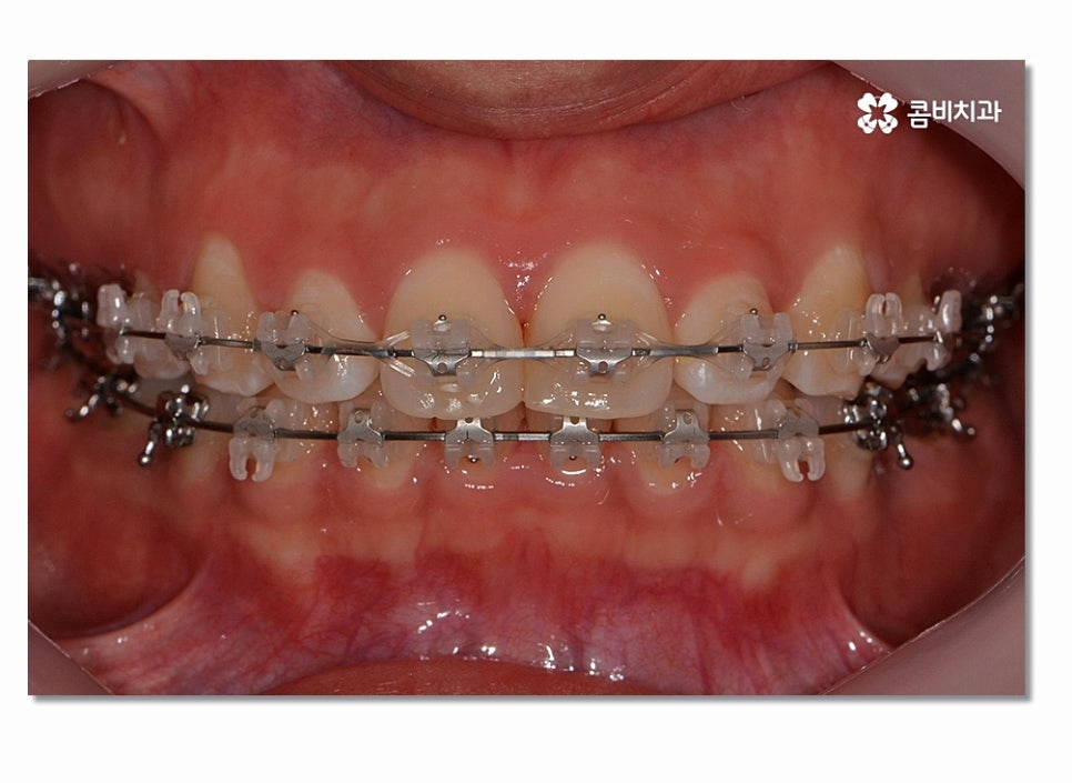 돌출입치아교정 부담이 크게 느껴진다면 관련 이미지 4