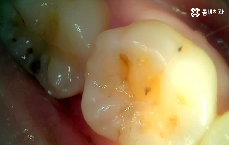 어금니 레진 깨짐 변색 안아파도 이렇게 대처하세요 관련 이미지 3