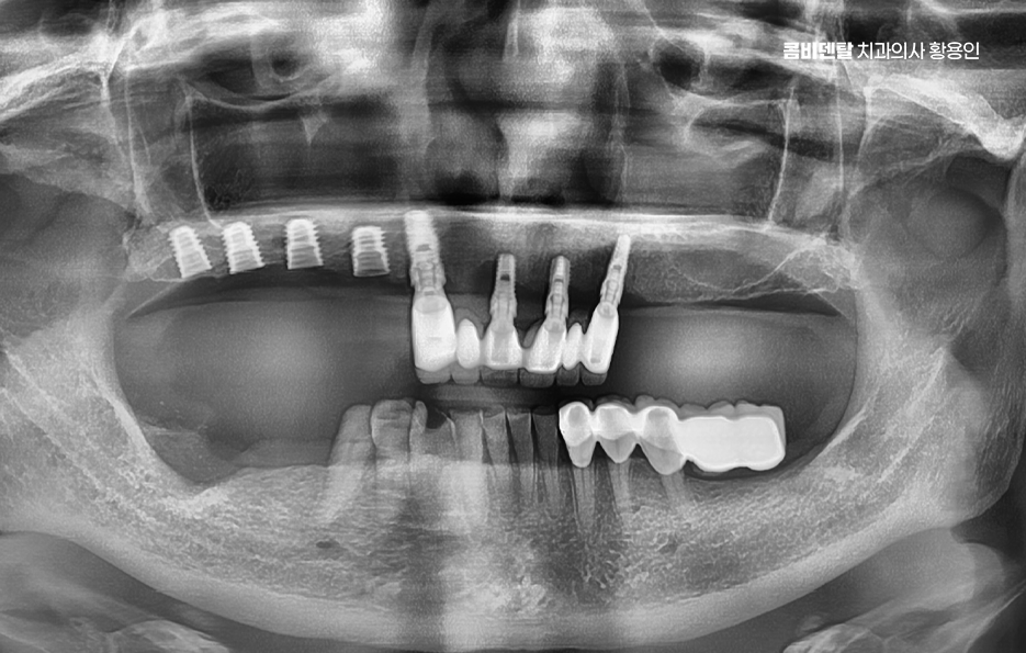 어금니 임플란트 뼈이식 이럴때 해당됩니다 관련 이미지 6