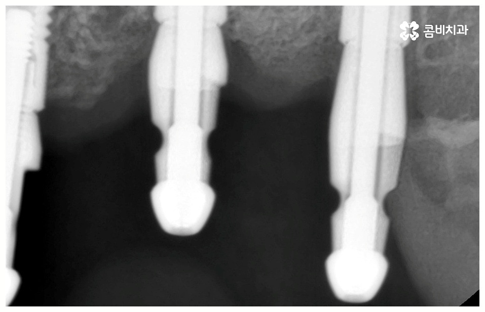 임플란트 치료기간 중점을 두어야 할것은 관련 이미지 6