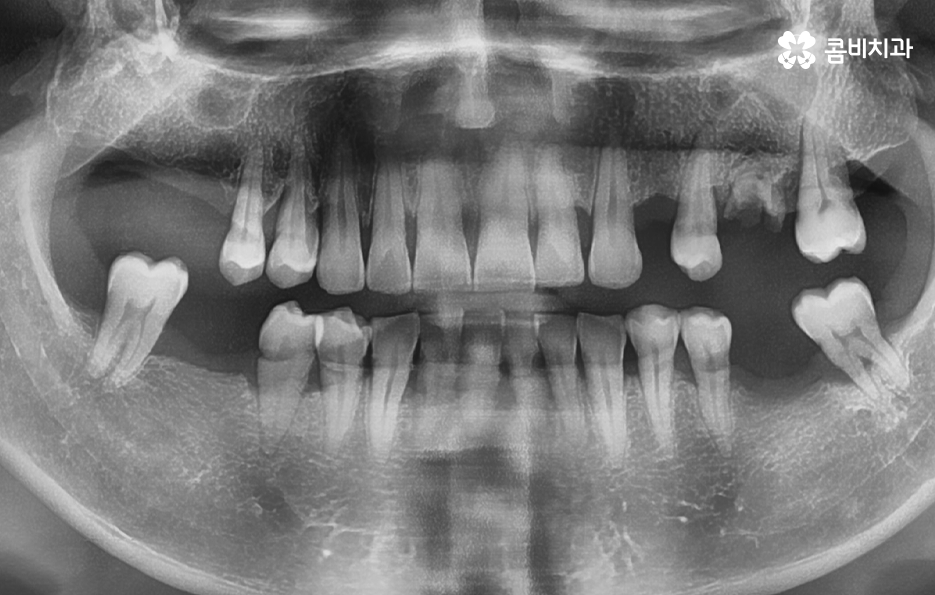 노인임플란트 이때부터 특히 조심하세요 관련 이미지 1