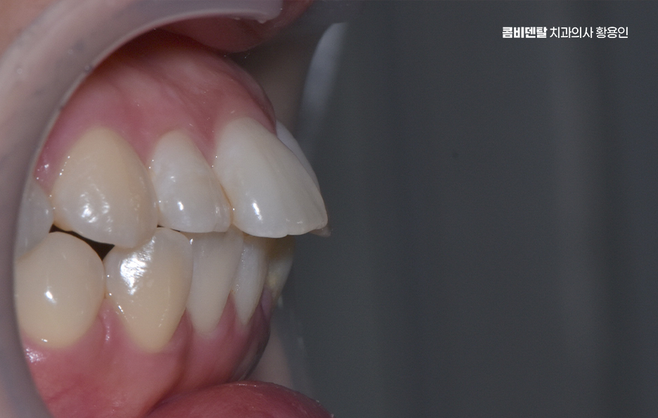 Could the Cause of Protruding Front Teeth Make a Difference? image 5