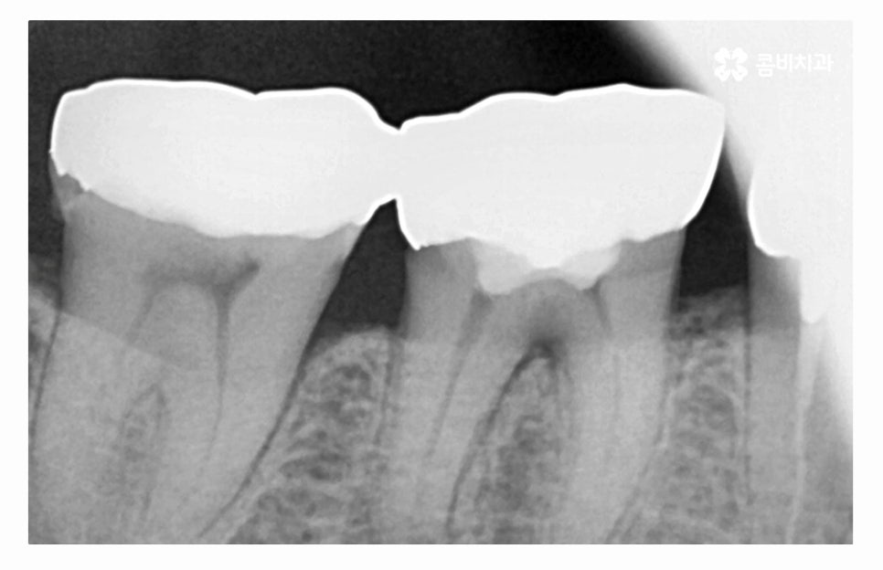 임플란트수술 제대로 알고 선택하려면 관련 이미지 3