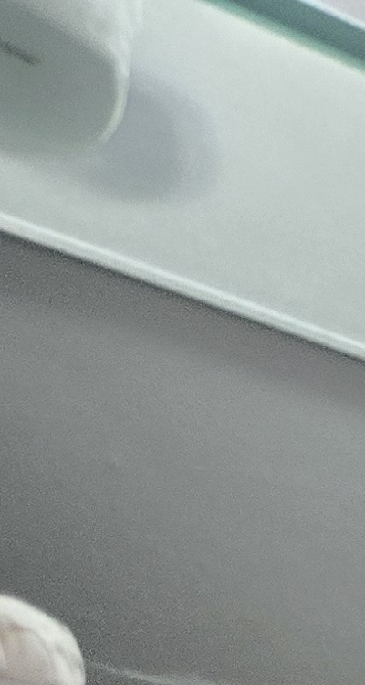 완전매복사랑니 발치 대학병원 꼭 가야하나요 관련 이미지 10