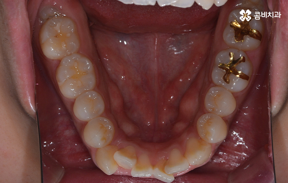 덧니 발치 교정 현명하게 선택하려면 관련 이미지 7
