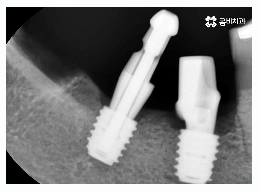 임플란트종류 잘알아보고 적용하려면 관련 이미지 6