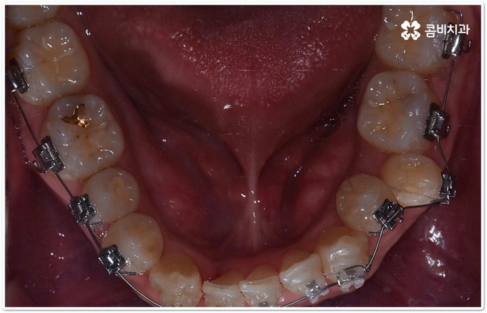 클리피씨교정 합리적인 초이스! 관련 이미지 8