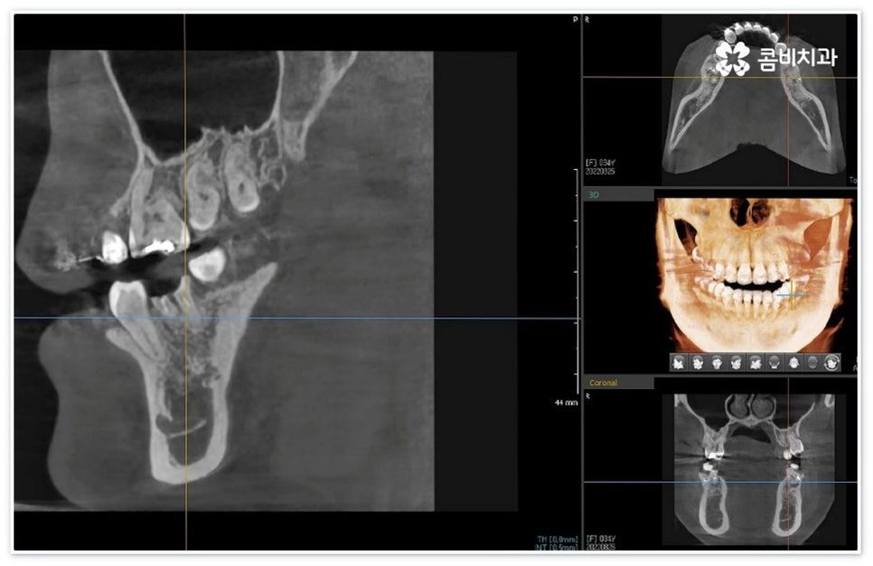신경치료통증 무섭다고 미루면 관련 이미지 3