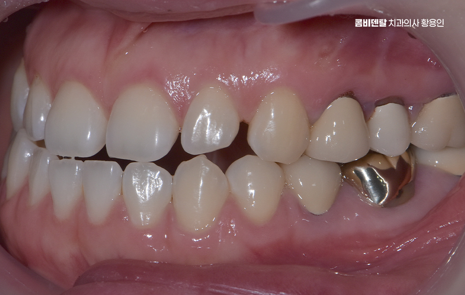 반대교합 치아교정 해결 가능할까 관련 이미지 3