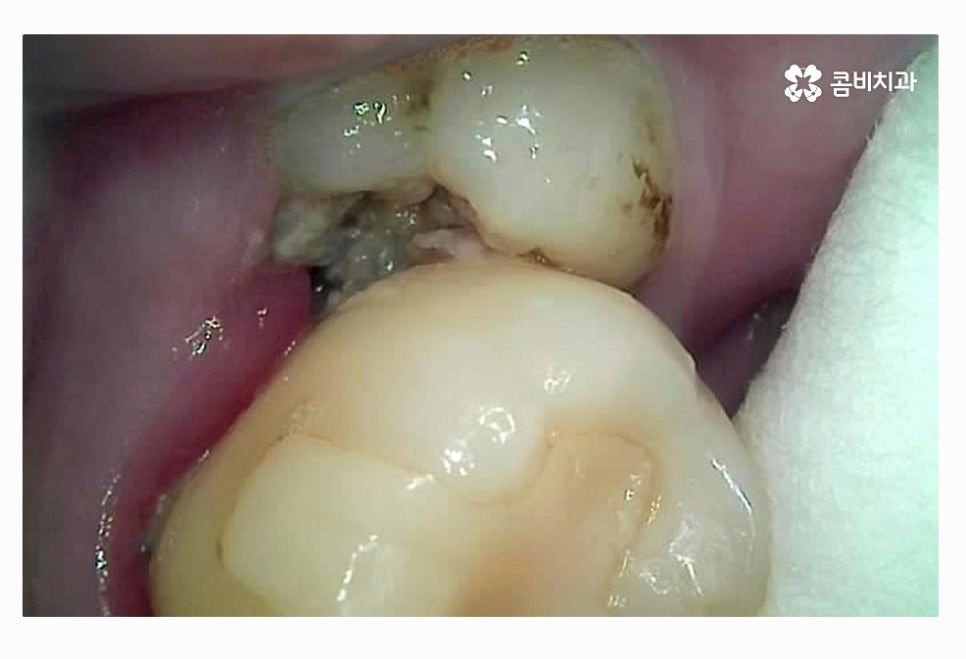 사랑니 충치 현명하게 접근하려면 관련 이미지 3