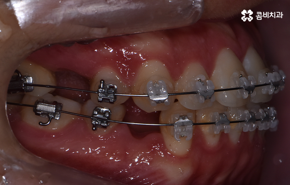 돌출입발치교정 기대해봐도 될까요 관련 이미지 7