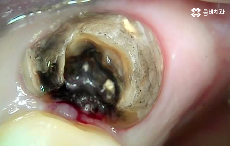 어금니 발치후 임플란트 이런점을 주의합시다 관련 이미지 3