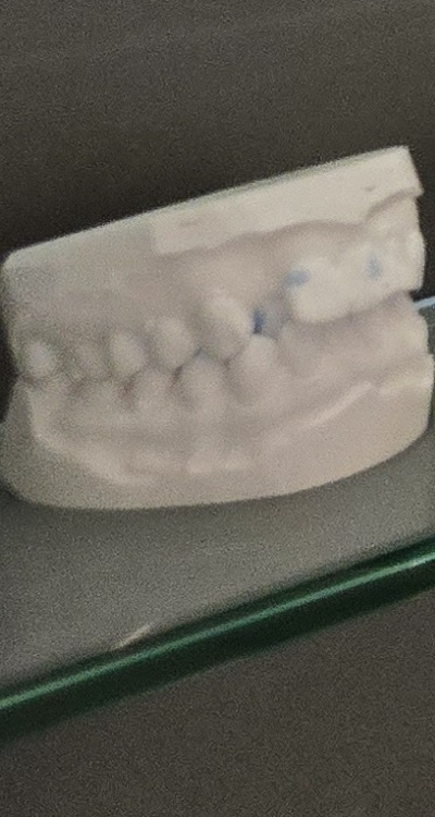 완전매복사랑니 발치 대학병원 꼭 가야하나요 관련 이미지 40