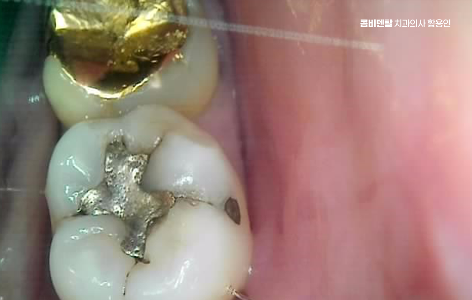 인레이 치료 후 신경치료 이유가 궁금하다면 관련 이미지 7