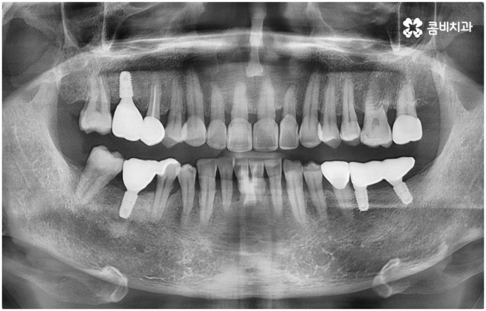 발치후 임플란트 바로 되나요? 관련 이미지 11