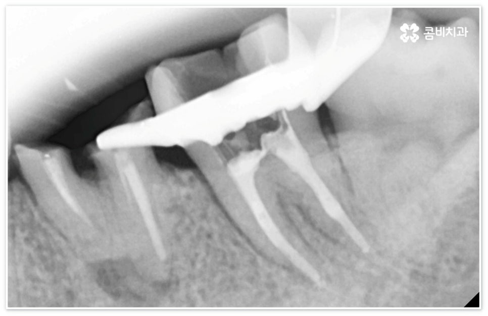 신경치료통증 무섭다고 미루면 관련 이미지 8