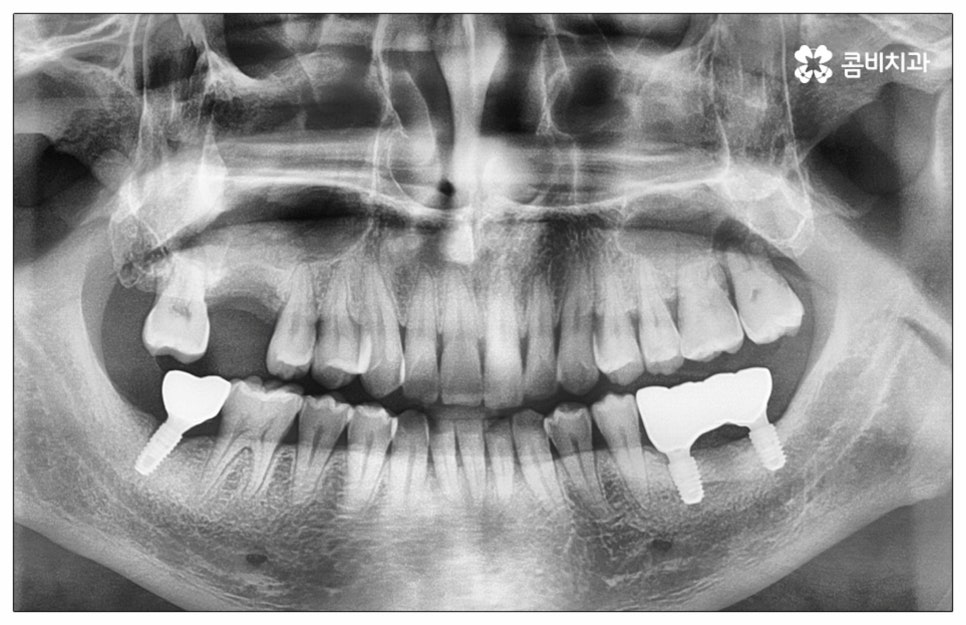 건강보험임플란트 혜택받아 보세요 관련 이미지 10