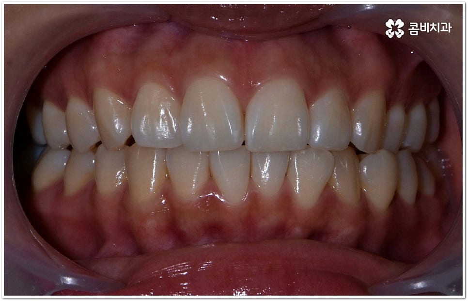 덧니부분교정 시작하려면 관련 이미지 3