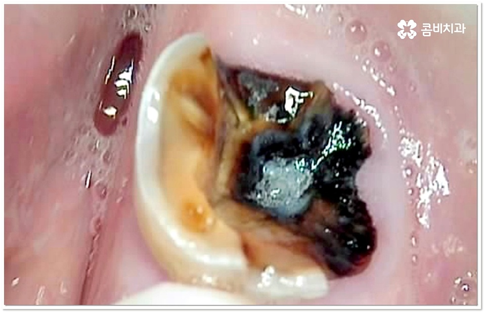 어금니 충치치료 빠를수록 좋아요 관련 이미지 6