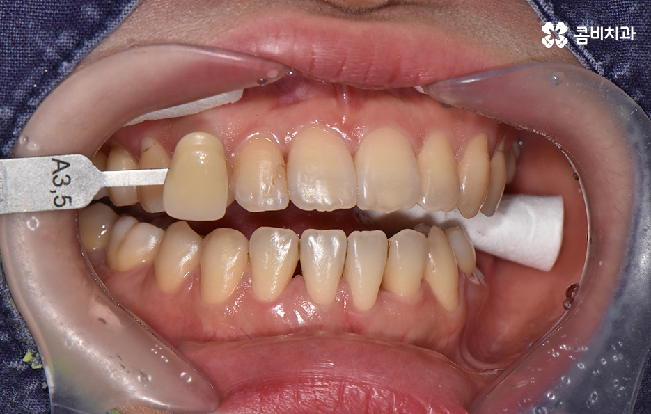 치과 치아미백 이렇게 시작해보세요 관련 이미지 3