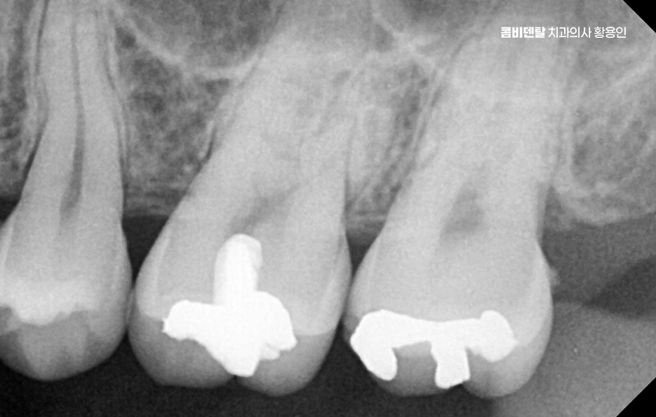 인레이 치료 후 통증 자꾸 심해지는데 괜찮은걸까 관련 이미지 5
