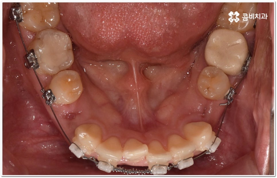 돌출입교정치과 알아보는 기준은 관련 이미지 11