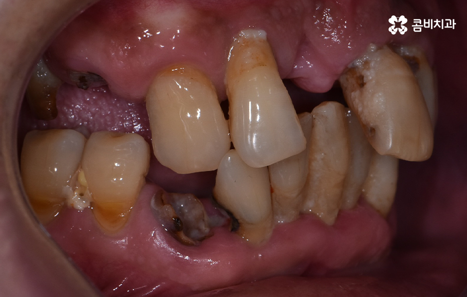 치주염 발치 이렇게나 심각하네요 관련 이미지 6