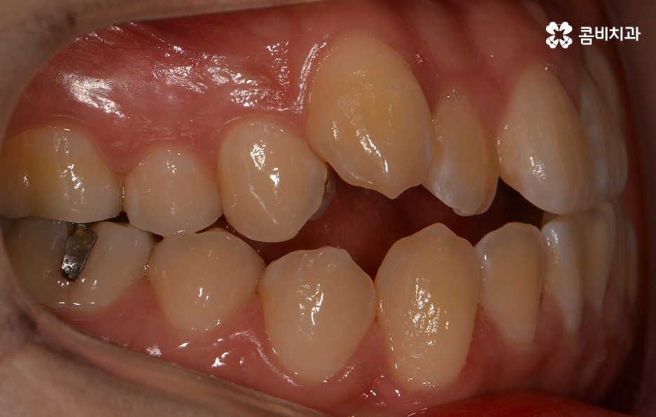송곳니 덧니 뽑지 않고 해결된 사례 관련 이미지 2