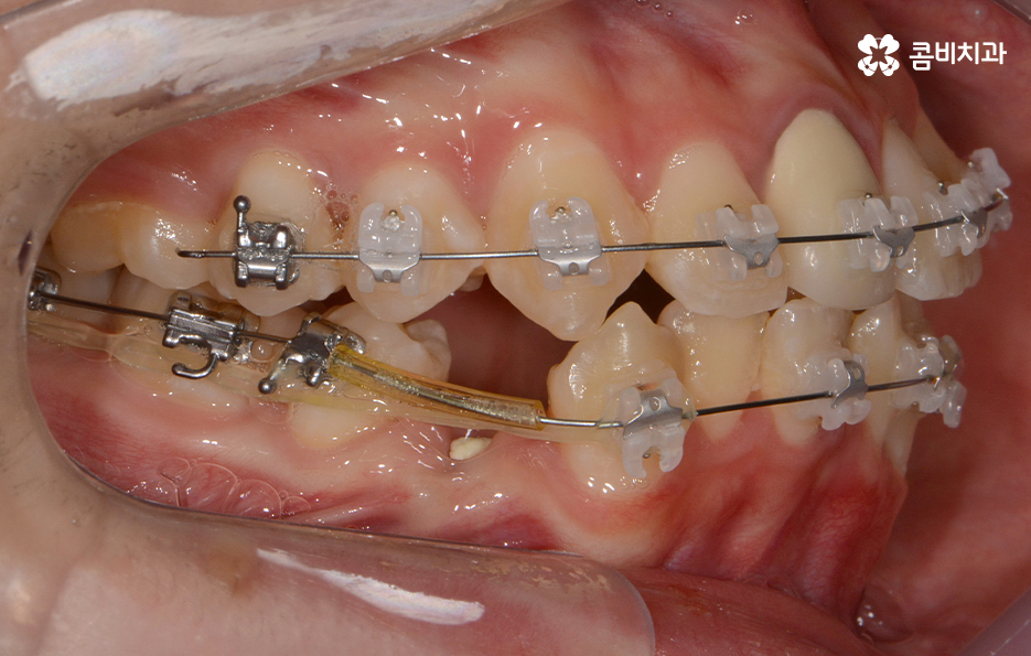 덧니교정 불편함이 느껴지지 않더라도 관련 이미지 8