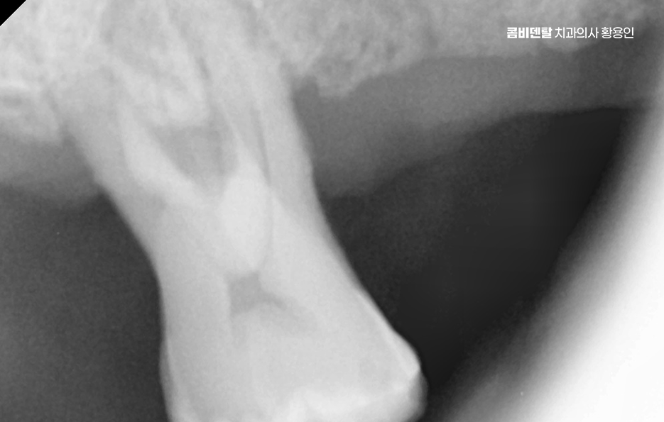 윗니 전체 임플란트 뭐부터 해야할까 관련 이미지 6