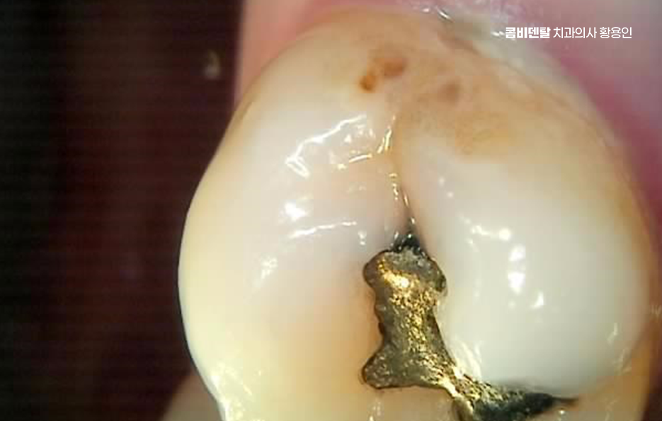 인레이 치료 후 신경치료 이유가 궁금하다면 관련 이미지 9