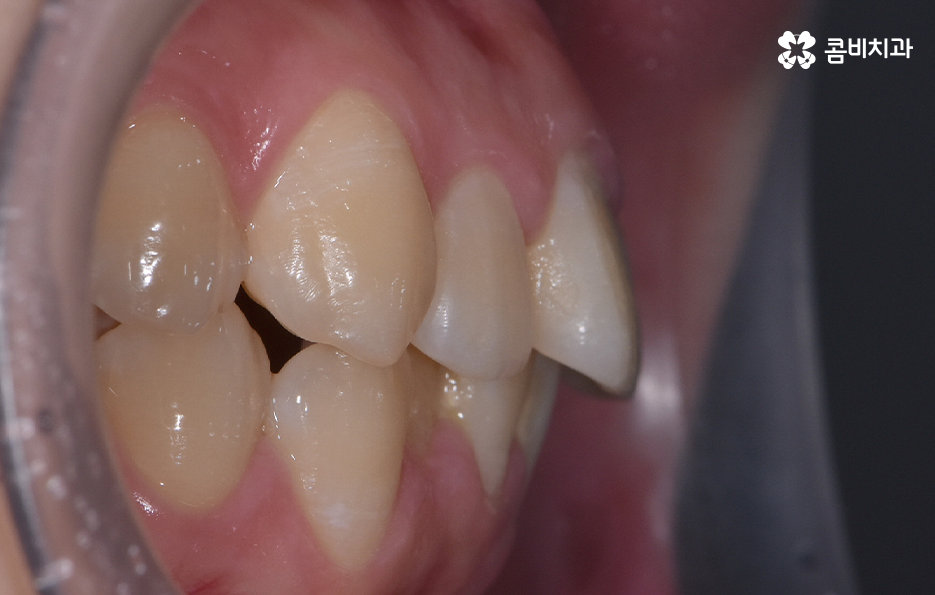 덧니 비발치 교정 자연스럽게 가능한 경우도 있어요 관련 이미지 4